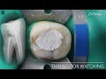 Root Canal Treatment in Mandibular Molar ⚪️ Protaper Next 🔵 Step By Step Demonstration