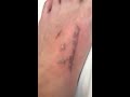 Up close tattoo laser removal