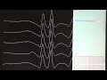 #Neuromuscular #junction tests (#Repetitive #Nerve #Stimulation and #Single #Fibre EMG)