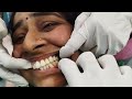 tooth replacement by dental bridge.