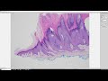 Wart under microscope.Verruca 101: More than you ever wanted to know! Pathology Dermatology Dermpath