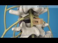 Posterior Lumbar Interbody Fusion (PLIF)