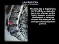 Low Back Pain Simple or Complicated - Everything You Need To Know - Dr. Nabil Ebraheim