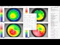 CSO Corneal AS-OCT + Placido Zeus MS-39 - Phoenix example