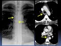 Chest Radiography: Lines & Tubes