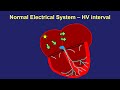 Diagnosis of SVT in the EP lab