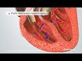 Blue Baby Heart Defect: Tetralogy of Fallot