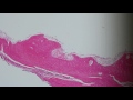 Basic Dermpath Cases  - Explained by a Dermatopathologist