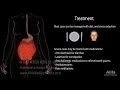 Irritable Bowel Syndrome: Pathophysiology, Symptoms, Causes, Diagnosis and Treatment, Animation