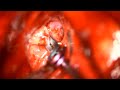 DIstal ACA aneurysm clipping - Mizzou Neurosurgery