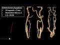 Imaging of Posterior Circulation Stroke - Basilar artery thrombosis and beyond (improved sound)