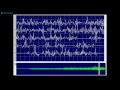 Kimura & Kohara: F64 Small, long-duration MUP showing typical early recruitment