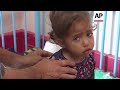 Children with underlying health conditions suffer severe malnutrition as Gaza famine risk stays high