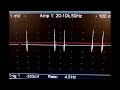 Multiple discharges of a single motor unit (doublets, triplets, multiplets)