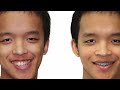 How to Fix Asymmetrical Jaw & Face (FOREVER)