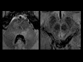 Imaging of demyelinating disorders (part 3) - NMOSD, MOGAD and ADEM