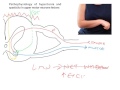 Pathophysiology of spasticity following UMN lesions