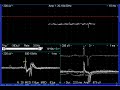 pacemaker artefact, 50 Hz artefact, fibrillation & positive sharp waves