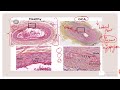 ISCHEMIC OPTIC NEUROPATHY || AION & PION || OPHTHALMOLOGY