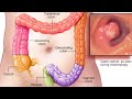 The Large Intestine