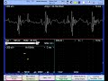 neurogenic EMG