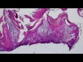 Basic Dermpath Cases - Explained by a Dermatopathologist