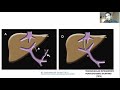 Esophageal Varices & Variceal Hemorrhage Treatment and Managment(STEP WISE APPROACH)