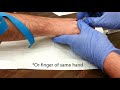 How to start an IV:  Dorsum of hand