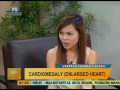 Good Morning Kuya: Cardiomegaly (Enlarged Heart)