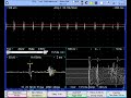 Myokymic discharges (doublets, triplets) in facial nerve lesion