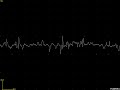 EMG myopathic vastus lateralis