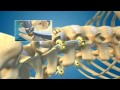 XLIF / DLIF Minimally Invasive Spine Surgery for Back Pain Animation - Dr. Neel Anand