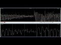 myotonic discharge