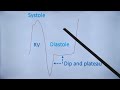 Square Root Sign in Constrictive Pericarditis