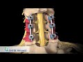 Posterior Cervical Laminectomy and Fusion