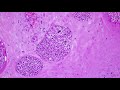 Chromoblastomycosis (Dematiaceous Black Mold Fungus Skin Infection): 5-Minute Pathology Pearls