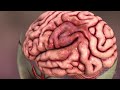 Brain Aneurysm Overview Animation