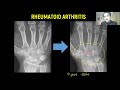 RHEUMATOID ARTHRITIS DIAGNOSIS CRITERIA,TREATMENT, NURSING MANAGEMENT RHEUMATOLOGY MEDICINE LECTURES