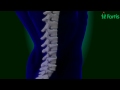 Vertebroplasty & Kyphoplasty ( Spine Surgery) Neuro Surgery; Fortis Healthcare,India