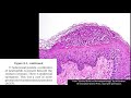 Inflammatory Dermpath 101 (A Beginner's Guide to Diagnosing Skin Rashes for Non-Dermatopathologists)