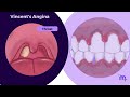 Acute Gingival Infections Part 01 | Periodontology | Animated Explanation