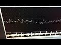 neuromyotonic discharges