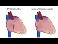 Atrial Septal Defects by D. Bailly | OPENPediatrics