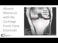 How to Read a Knee MRI for Meniscus Tears