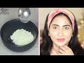 Teenager Skin Transformation Challenge-Pimples, whiteheads, acne marks clearing & face brightening