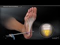 Endoscopic Plantar Fascia Release