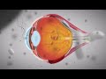 Eye Floaters: What Are They & What Causes Them?