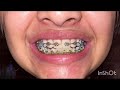 beautiful transformation with dental braces