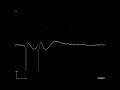 Waxing-waning discharge from a denervated muscle