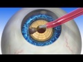 LENSAR Laser Cataract Surgery Parkhurst NuVision San Antonio